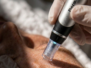 Microneedling behandeling close-up